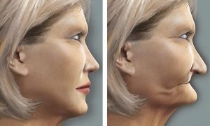 Zmiana rysów twarzy przy zaniku kości